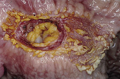 pig-severe-ulcer-pars-oesophagea-.jpg