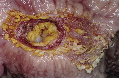 pig-severe-ulcer-pars-oesophagea-.jpg
